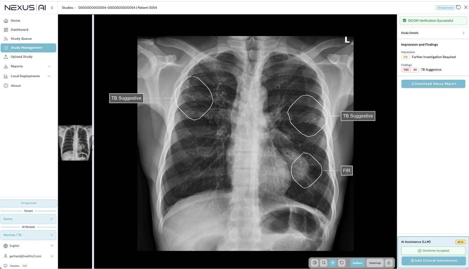 TB screening software marking three lung areas as TB suggestive on a chest X-ray